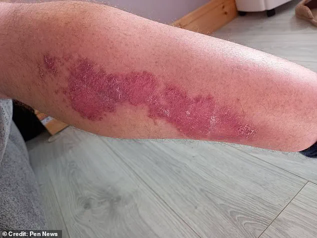 Britain's Most Dangerous Spider Sparks Health Crisis and Community Concerns After Devastating Bite Leaves Worker Hospitalized