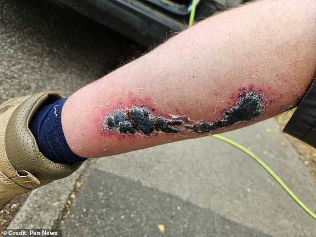 Britain's Most Dangerous Spider Sparks Health Crisis and Community Concerns After Devastating Bite Leaves Worker Hospitalized