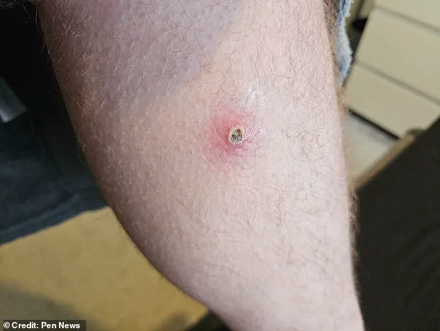 Britain's Most Dangerous Spider Sparks Health Crisis and Community Concerns After Devastating Bite Leaves Worker Hospitalized