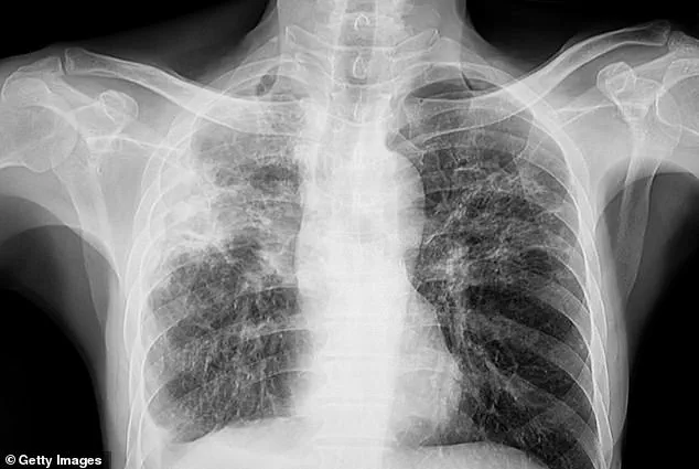 Three Unrelated TB Cases in Maine Prompt Public Health Response as Experts Highlight Transmission Risks