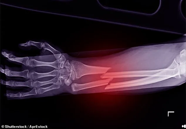Urgent Call to Expand Fracture Services as Campaigners Warn of Rising Osteoporosis-Related Deaths