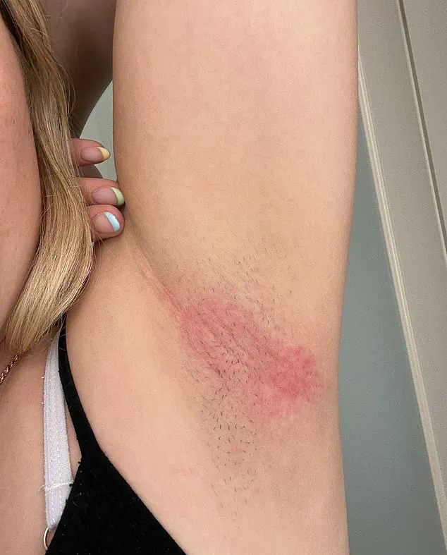 Mitchum's Deodorant Faces New Complaints Over Painful Reactions, Sparking Safety Concerns
