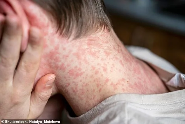 Robert F Kennedy Jr Reverses Stance, Endorses MMR Vaccine Against Measles