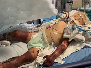 Study Reveals Increased Risk of Sepsis in Americans with Type 2 Diabetes