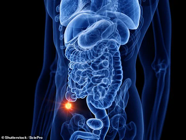 Surge in Appendix Cancer Among Younger Adults Sparks Medical Concern