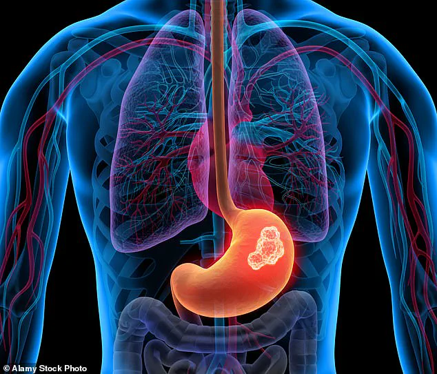 Urgent Warning: Persistent Heartburn Could Signal Serious Conditions, Including Cancer