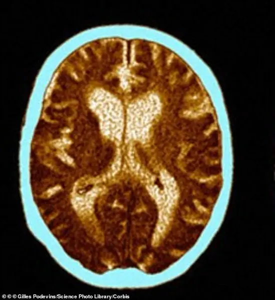 New Study Links Crow’s Feet to Increased Alzheimer’s Risk, Raising Questions About Early Detection