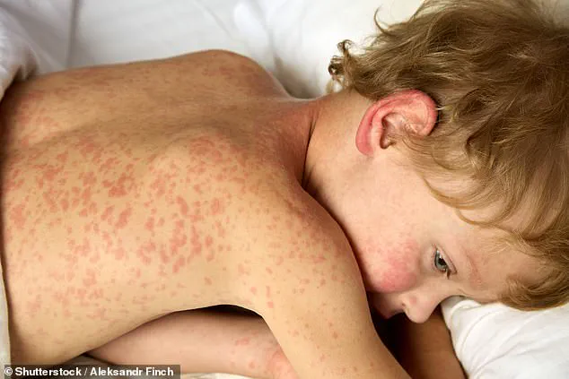 U.S. Measles Outbreak Surpasses 2,000 Cases, Largest Since 1992, as Health Officials Issue Urgent Warnings