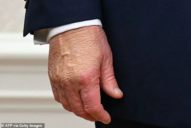 White House Explains Trump's Bruised Hand as Result of Davos Event Incident