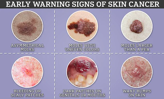 Melanoma's Hidden Threat: The Uncommon Eye Risk You Might Be Overlooking