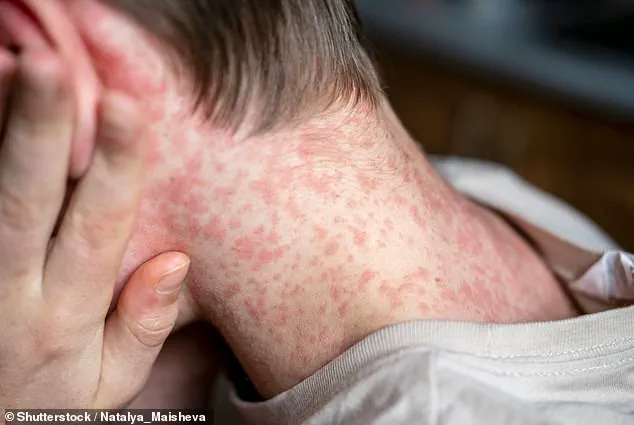 Measles Outbreak at Texas Immigration Detention Center Prompts ICE to Halt Movement, Public Health Alert Issued