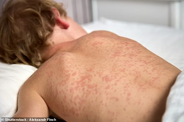 Ava Maria University Confirms 57 Measles Cases Amid Nationwide Surge