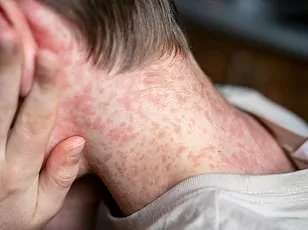 CDC Issues Level 2 Travel Advisory for Bolivia Amid Chikungunya Resurgence