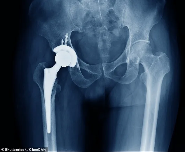 Heraeus Failure Sparks NHS Crisis, Million Joint Surgeries Threatened