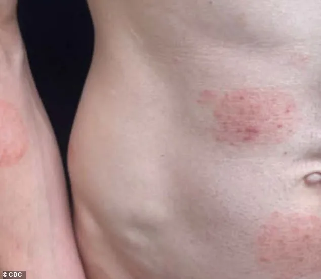 Minnesota's Largest Ringworm Outbreak: 40 Cases of Rare Fungal Infection TMVII Reported