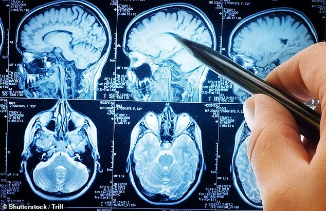 Parkinson's Disease: The Hidden Progression Before Symptoms Emerge