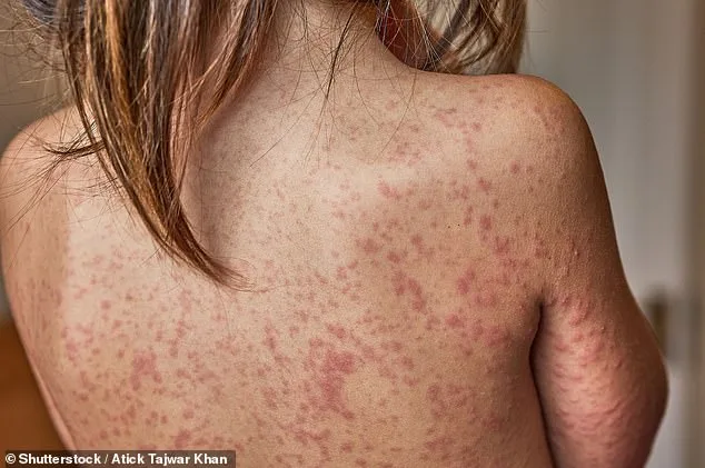 Trump Administration Launches Urgent Push for Measles Vaccination Amid South Carolina Outbreak