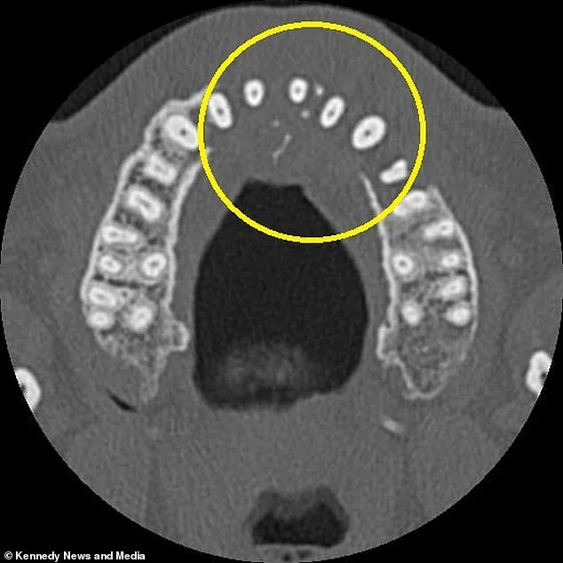 Toothache Reveals Blood Cancer: A Warning to Ignore Minor Symptoms