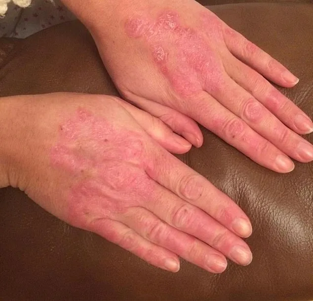 Janine Price's 20-Year Battle with Psoriasis: From Pregnancy to Unrelenting Pain and the Quest for Relief