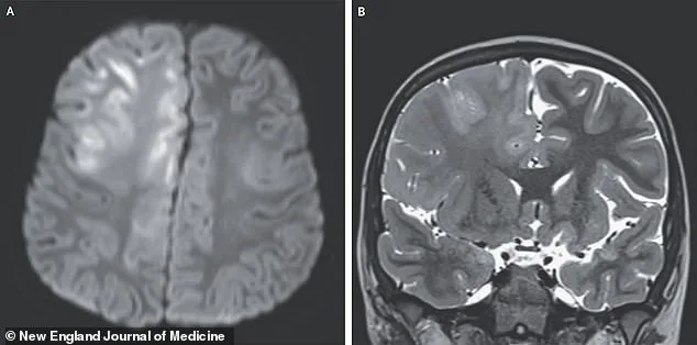Measles Resurgence Sparks Fears of Deadly Complication: SSPE Linked to U.S. Outbreak
