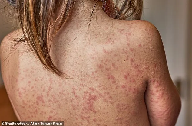 Measles Crisis Forces London Schools to Consider Excluding Unvaccinated Children as Health Officials Sound Alarms