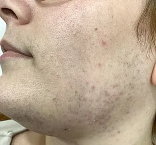 The Hidden Burden of Hirsutism: Georgia's Struggle with PCOS